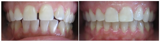 Invisalign orthodontic treatment for closing gaps