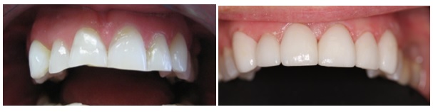 Porcelain veneers- used to restore the shape and esthetics of worn out or discolored teeth