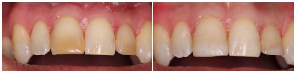 White composite filling- replacement of old discolored composite resin