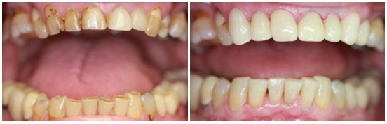 CEREC restaurations done in one session to restore and reinforce a worn down and undermined dentitio