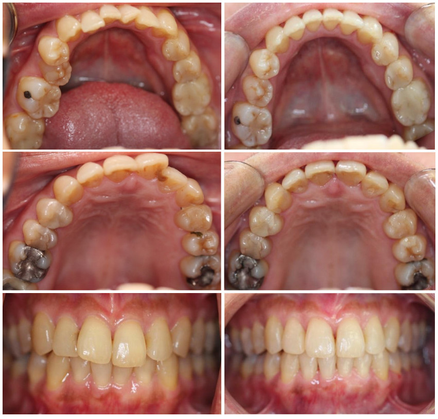 L’orthodontie par Invisalign: Avant et après 12 mois de traitement